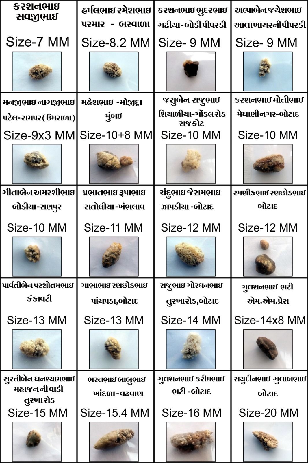 Kidney Stone Treatment Results